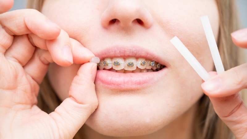 Wax for Braces: What It Is & How to Use It